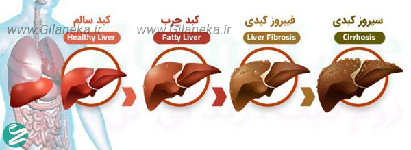کبد چرب سایت گیلانیکا