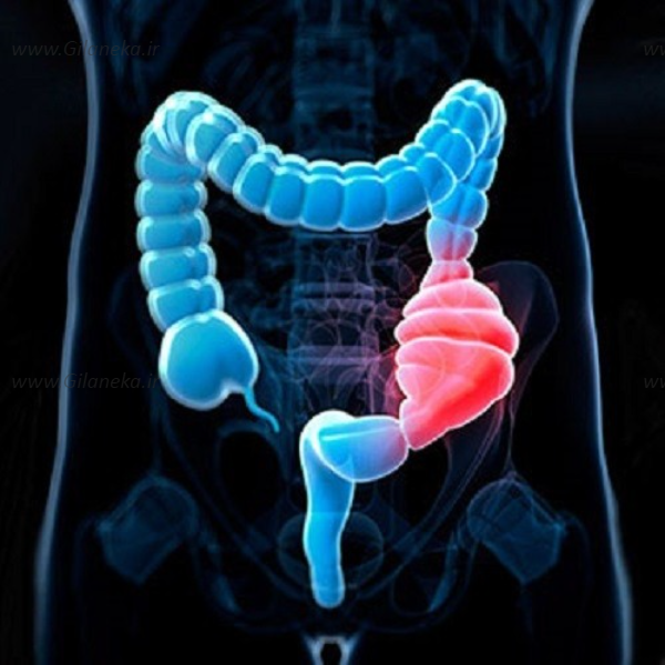 از بین بردن IBS (سندروم روده تحریکپذیر)